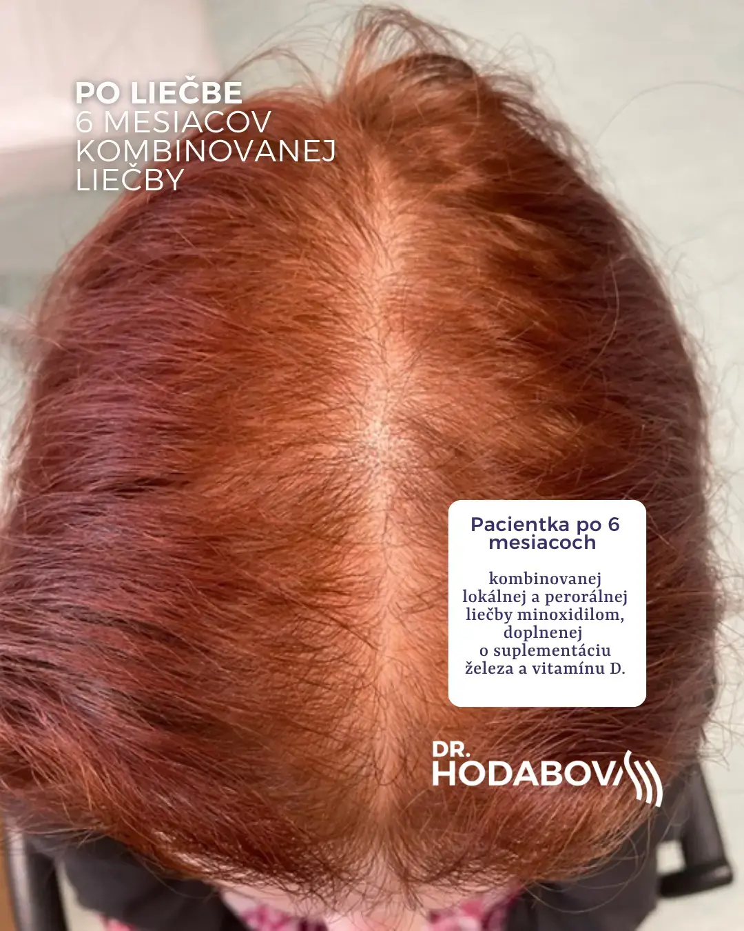 Kombinovaná liečba vypadávania vlasov – po